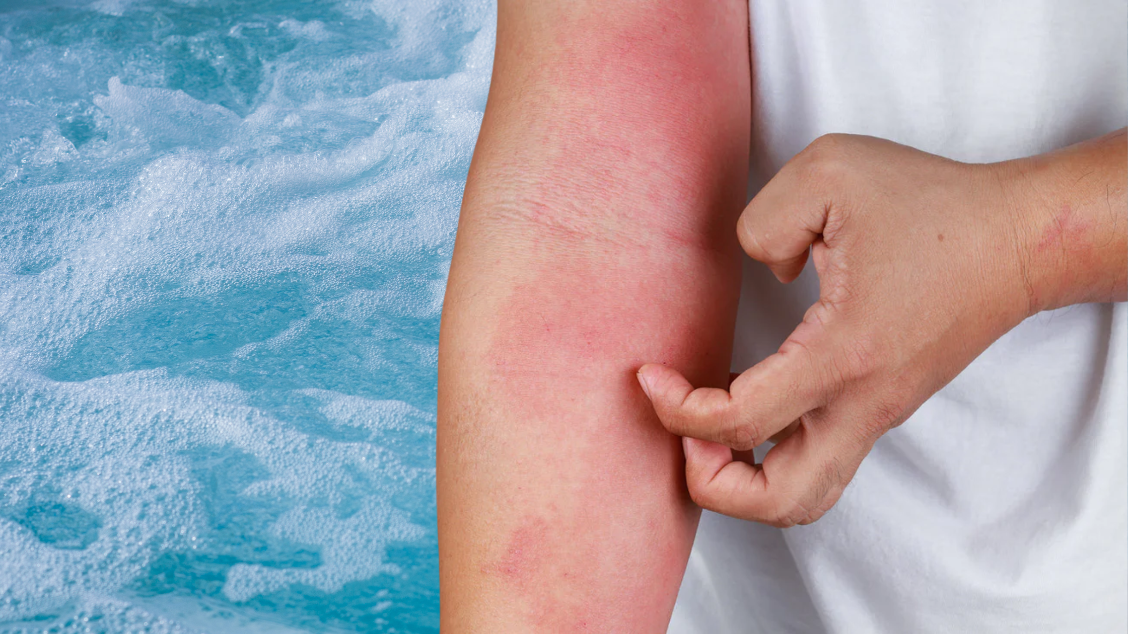 Eczema and Hot Tubs: Your Guide to Safe Soaking