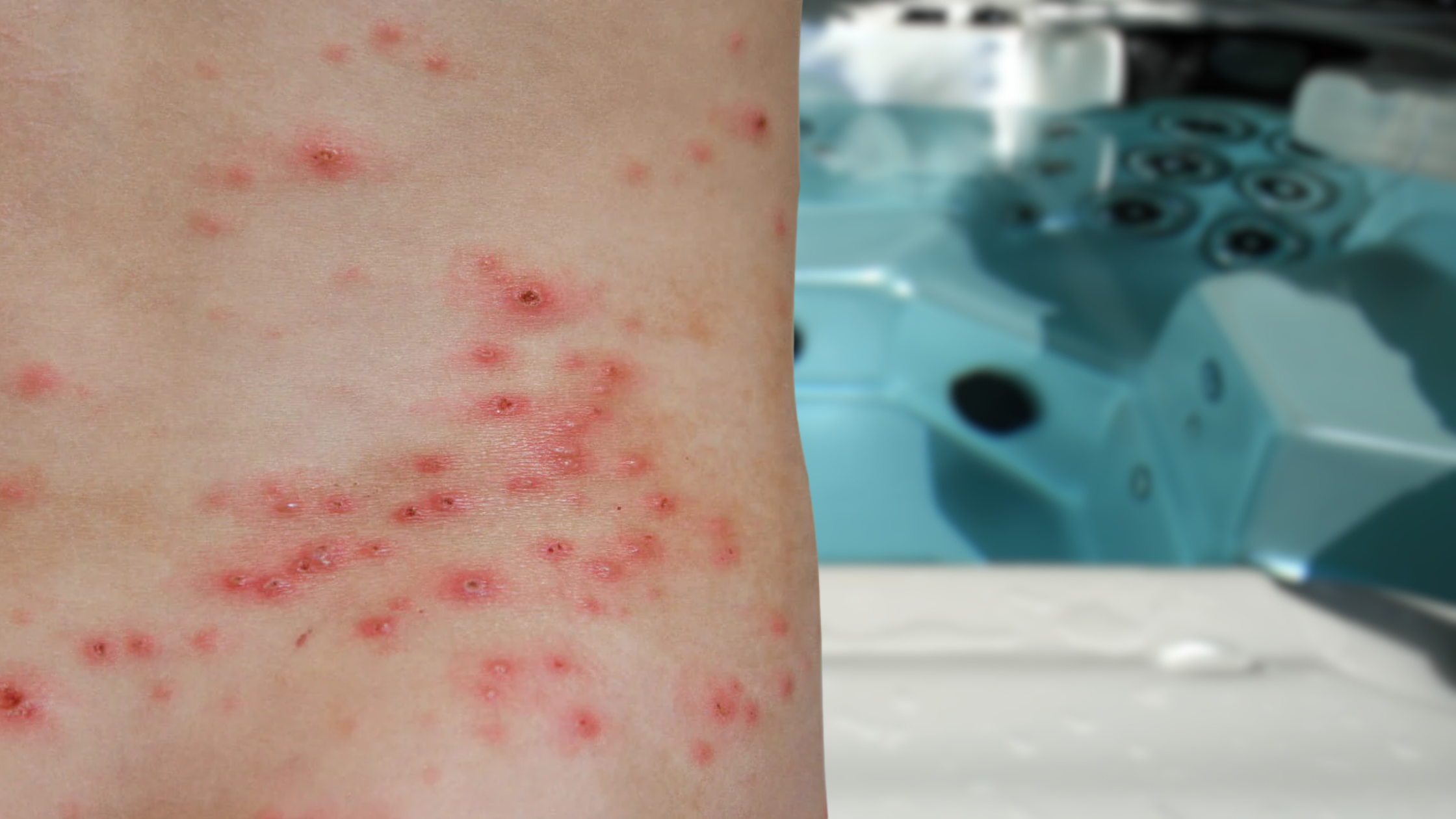 Hot Tub Folliculitis Guide for Owners
