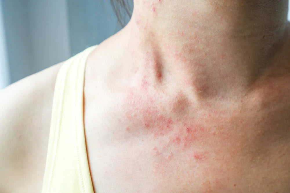 Hot Tub Rash Causes: Why It Happens & How to Prevent It